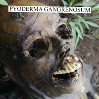 Pyoderma Gangrenosum - Session 1 (2015)