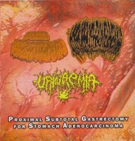 Fascitis Necrotizante & Urinaemia & Hypoprothrombinemia - Proximal Subtotal Gastrectomy For Stomach Adenocarcinoma (Split) (2015)