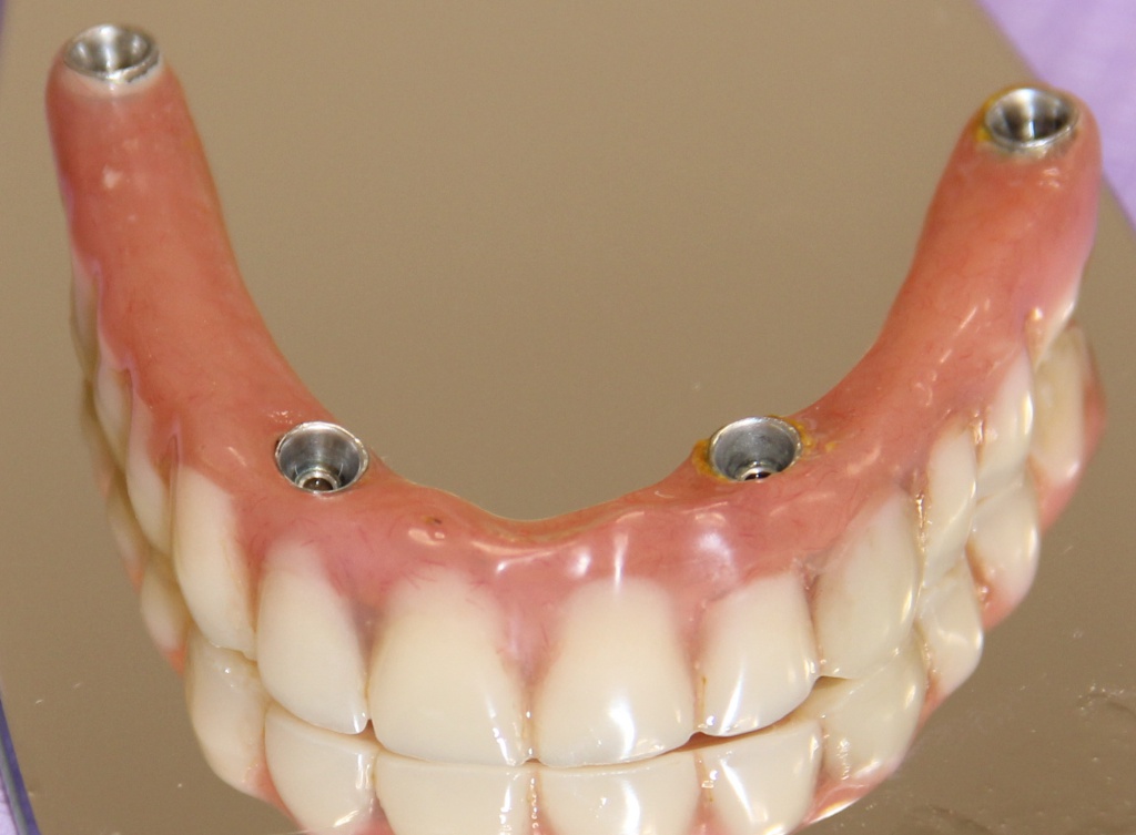 Восстановление зубов методом 